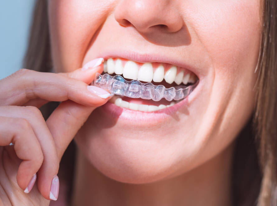 woman-with-perfect-smile-wearing-invisible-dental-aligners-dental-correction
