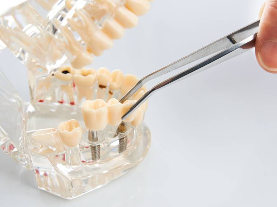 impianto dentale