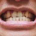 Denti disallineati: perché non ignorarli e come intervenire