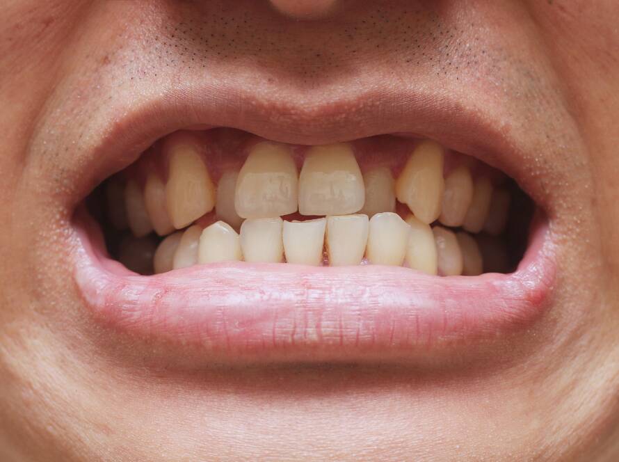 Denti disallineati