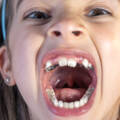 Agenesia dentale: denti mancanti nei bambini
