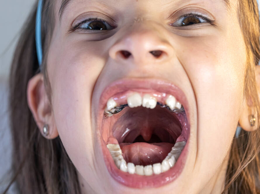 Denti mancanti dalla nascita: cos’è l’agenesia dentale